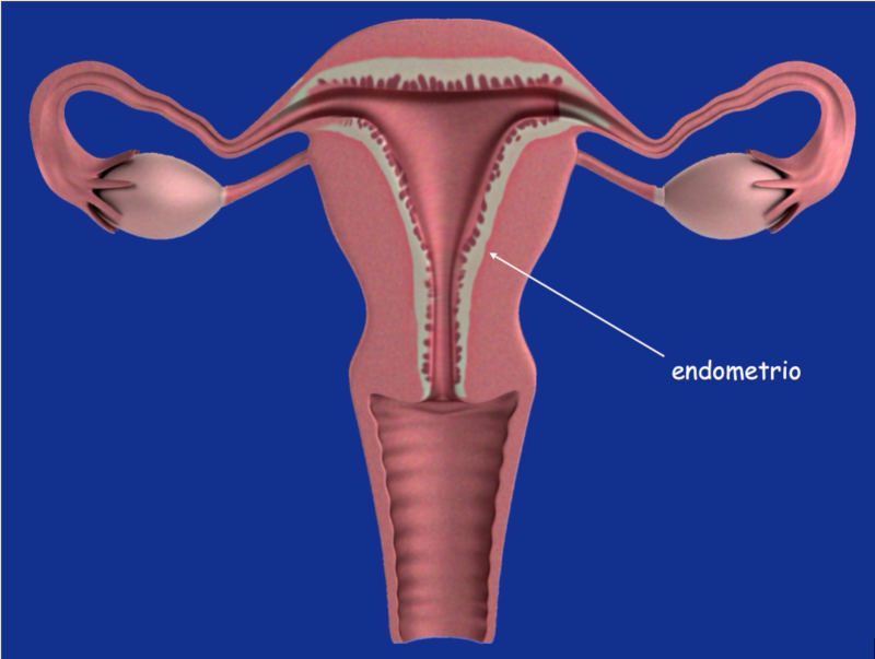 Endometriosis: un trastorno de células okupas